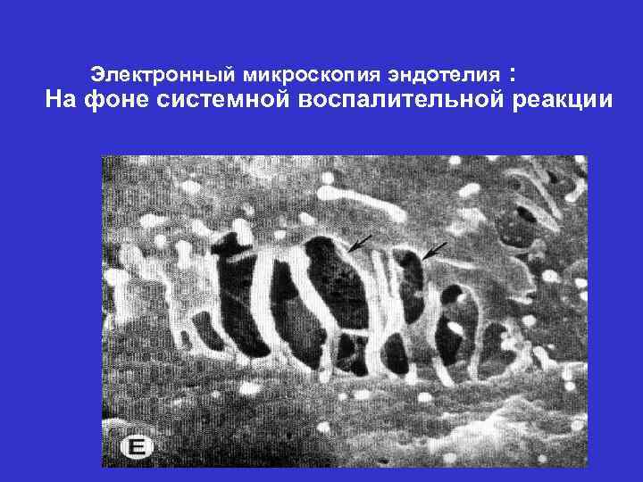 Электронный микроскопия эндотелия : На фоне системной воспалительной реакции 