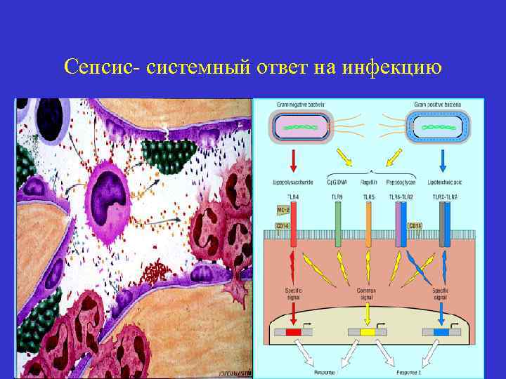 Сепсис- системный ответ на инфекцию 