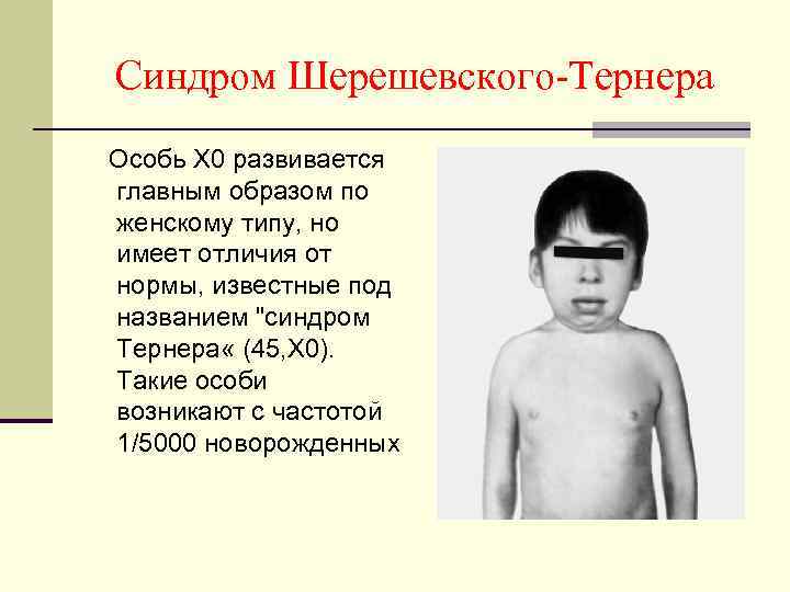 Синдром Шерешевского-Тернера Особь X 0 развивается главным образом по женскому типу, но имеет отличия