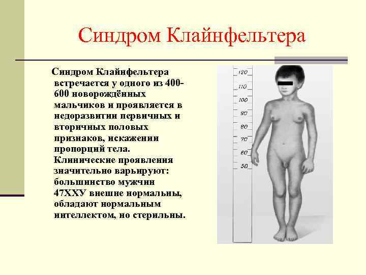Синдром Клайнфельтера встречается у одного из 400600 новорождённых мальчиков и проявляется в недоразвитии первичных