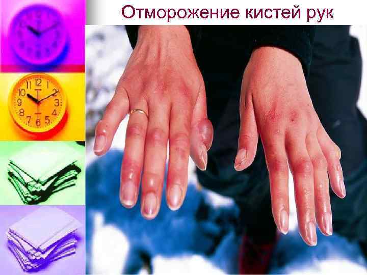Отморожение кистей рук 