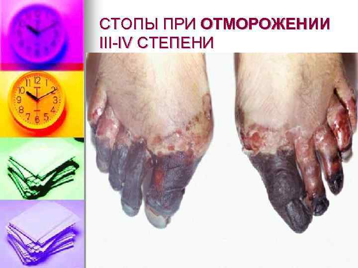 СТОПЫ ПРИ ОТМОРОЖЕНИИ III-IV СТЕПЕНИ 