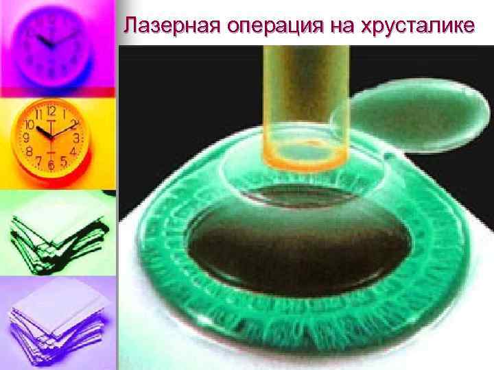 Лазерная операция на хрусталике 