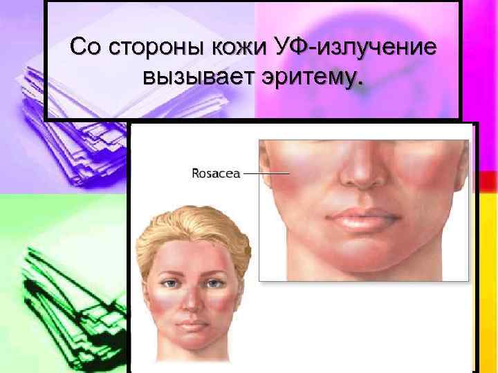 Со стороны кожи УФ-излучение вызывает эритему. 