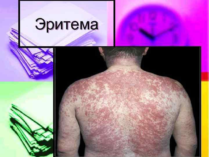 Эритема 