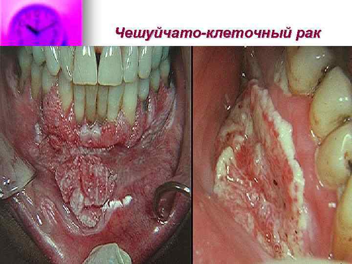 Чешуйчато-клеточный рак 