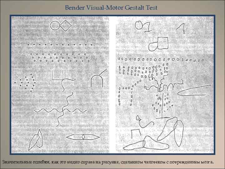 Bender Visual-Motor Gestalt Test Значительные ошибки, как это видно справа на рисунке, сделанном человеком