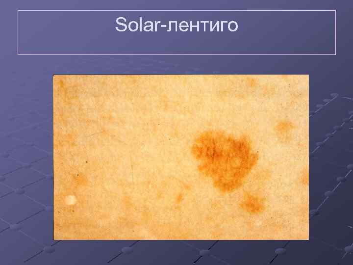 Solar-лентиго 