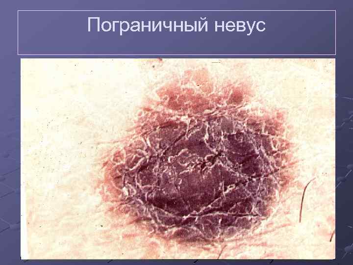 Эритроплазия кейра фото