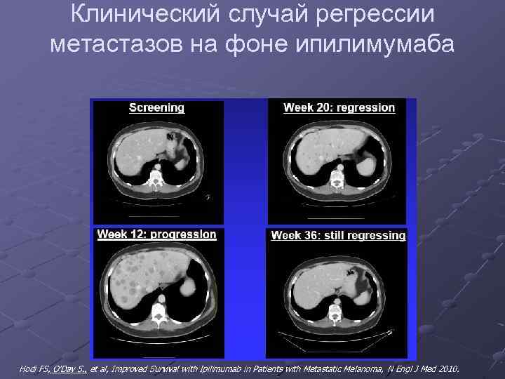 Клинический случай регрессии метастазов на фоне ипилимумаба Hodi FS, O’Day S. , et al,