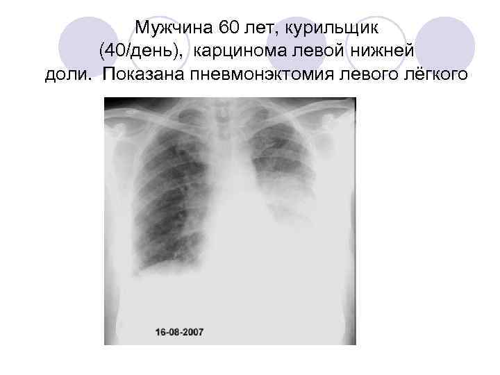 Мужчина 60 лет, курильщик (40/день),  карцинома левой нижней доли.  Показана пневмонэктомия левого лёгкого 