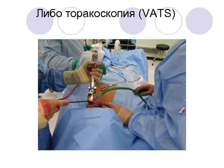 Либо торакоскопия (VATS) 