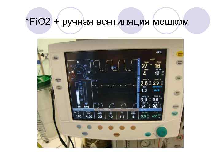 ↑Fi. O 2 + ручная вентиляция мешком 
