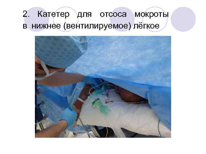 2. Катетер для отсоса мокроты в нижнее (вентилируемое) лёгкое 