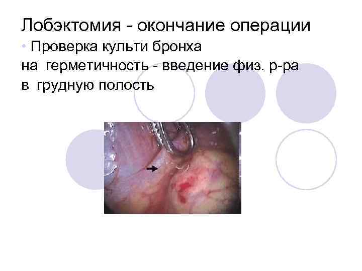 Лобэктомия - окончание операции • Проверка культи бронха на герметичность - введение физ. р-ра в грудную
