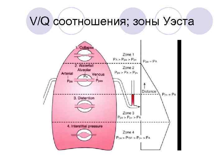 V/Q соотношения; зоны Уэста 