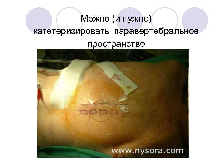 Можно (и нужно) катетеризировать паравертебральное пространство 