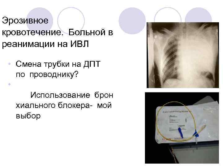 Эрозивное кровотечение.  Больной в реанимации на ИВЛ • Смена трубки на ДПТ по проводнику? •