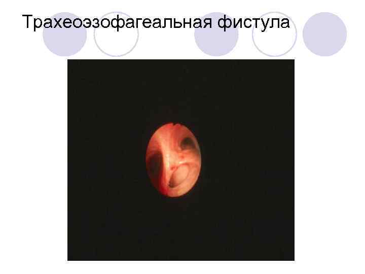 Трахеоэзофагеальная фистула 