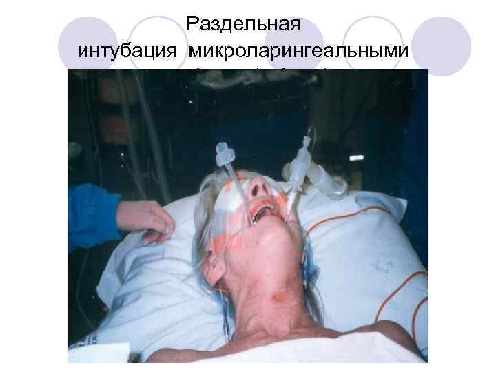 Раздельная интубация микроларингеальными трубками (5 -6 мм) 
