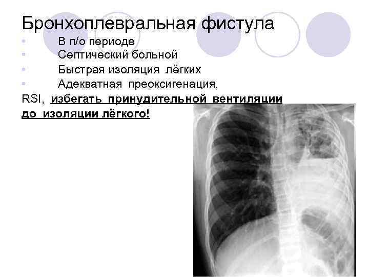 Бронхоплевральная фистула • В п/о периоде • Септический больной • Быстрая изоляция лёгких • Адекватная преоксигенация,
