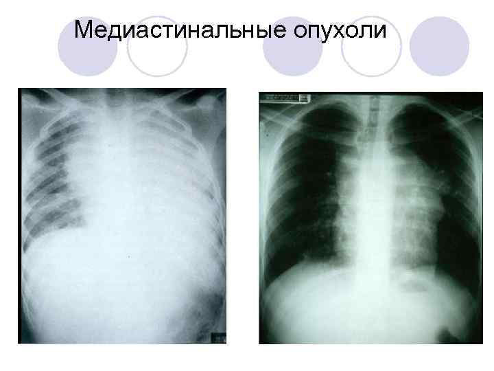 Медиастинальные опухоли 