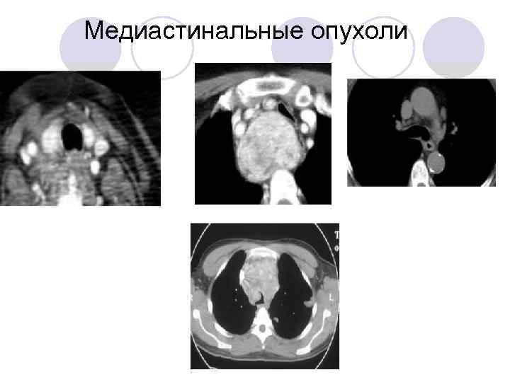 Медиастинальные опухоли 