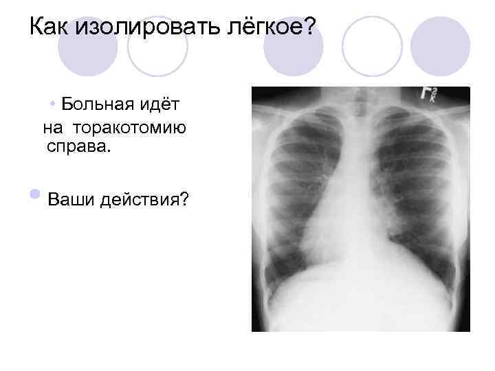 Как изолировать лёгкое? • Больная идёт на торакотомию справа. • Ваши действия? 