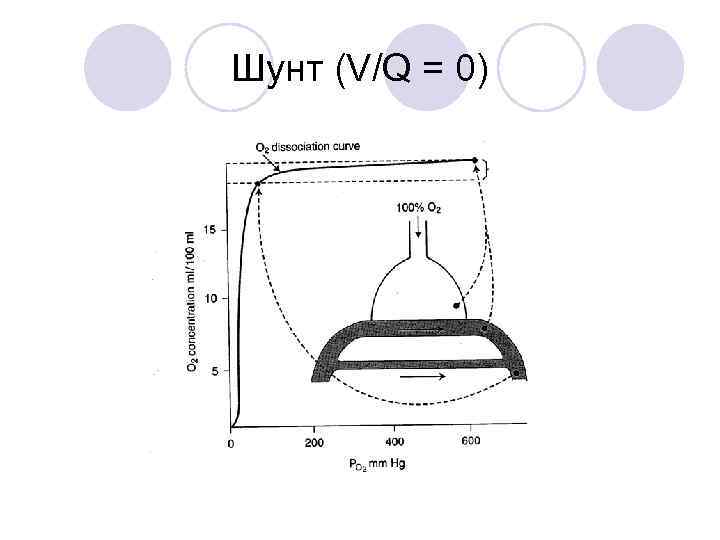 Шунт (V/Q = 0) 