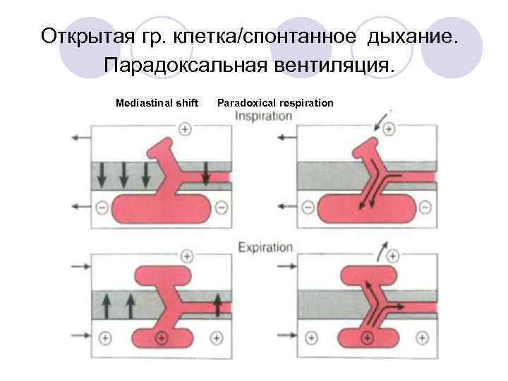 Открытая гр. клетка/спонтанное дыхание. Парадоксальная вентиляция. Mediastinal shift Paradoxical respiration i : » : ~