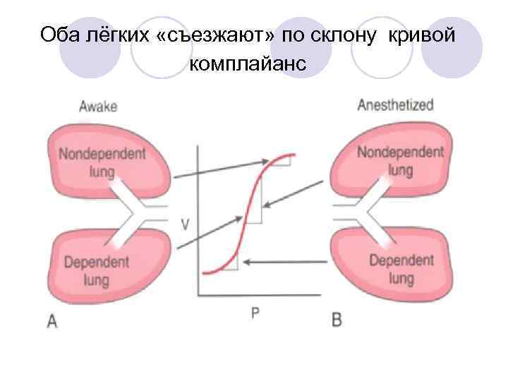 Оба лёгких «съезжают» по склону кривой комплайанс 