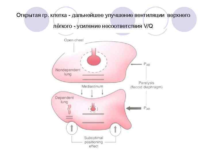 Открытая гр. клетка - дальнейшее улучшение вентиляции верхнего лёгкого - усиление несоответствия V/Q 