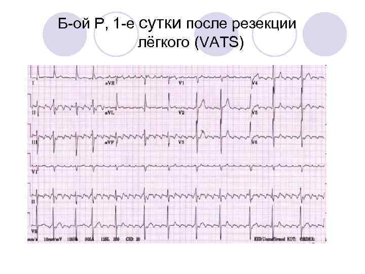 Б-ой Р, 1 -е сутки после резекции лёгкого (VATS) 