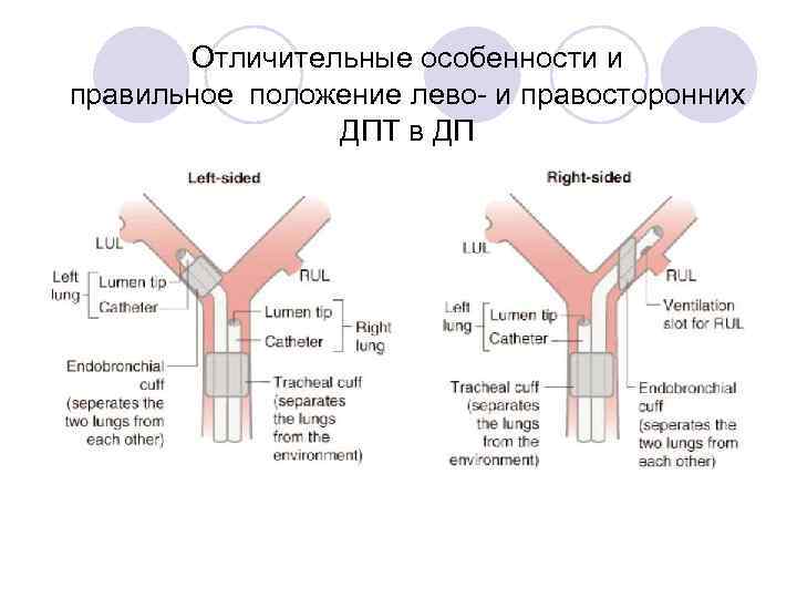 Отличительные особенности и правильное положение лево- и правосторонних ДПТ в ДП 