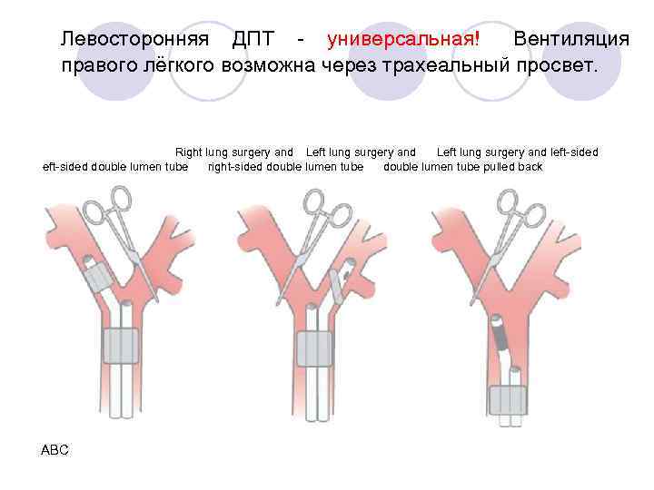 Левосторонняя ДПТ - универсальная!  Вентиляция правого лёгкого возможна через трахеальный просвет. Right lung surgery