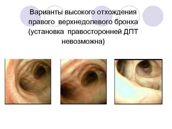 Варианты высокого отхождения правого верхнедолевого бронха (установка правосторонней ДПТ невозможна) 