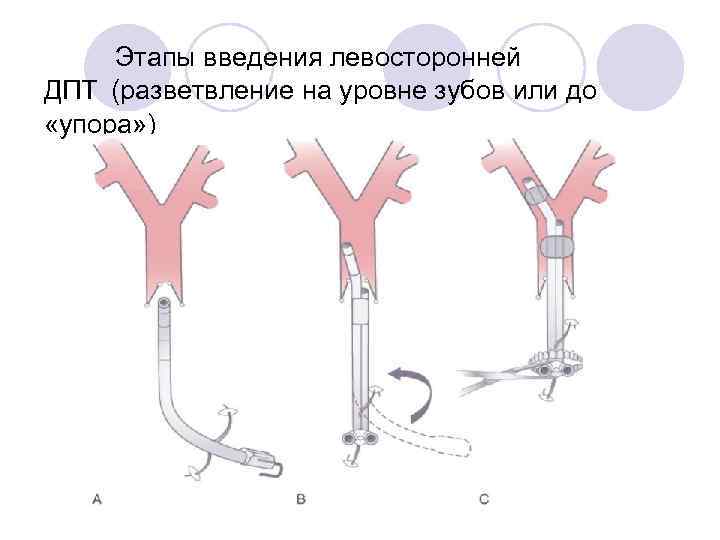 Этапы введения левосторонней ДПТ (разветвление на уровне зубов или до «упора» ) 