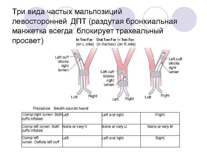 Три вида частых мальпозиций левосторонней ДПТ (раздутая бронхиальная манжетка всегда блокирует трахеальный In Too Far Out