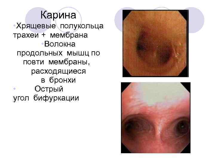 Карина • Хрящевые полукольца трахеи + мембрана • Волокна продольных мышц по повти мембраны,   расходящиеся в бронхи •