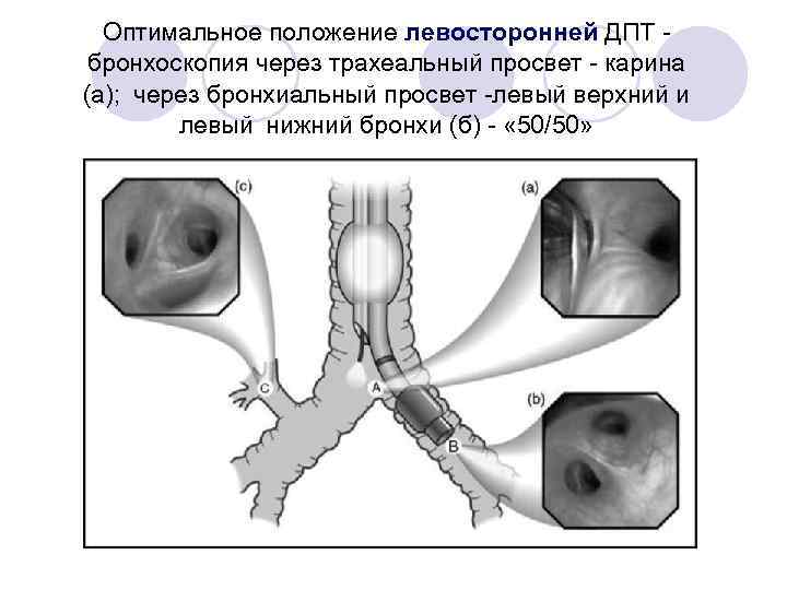 Оптимальное положение левосторонней ДПТ бронхоскопия через трахеальный просвет - карина (а);  через бронхиальный просвет