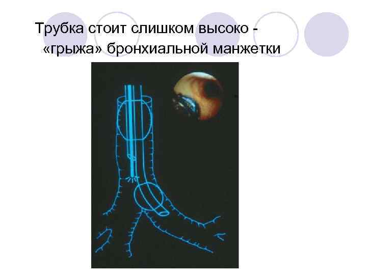 Трубка стоит слишком высоко   «грыжа» бронхиальной манжетки 