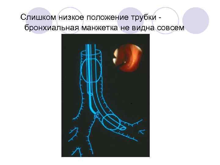 Слишком низкое положение трубки  бронхиальная манжетка не видна совсем 