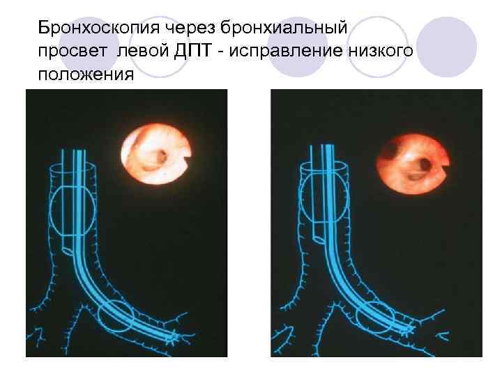 Бронхоскопия через бронхиальный просвет левой ДПТ - исправление низкого положения трубки. 