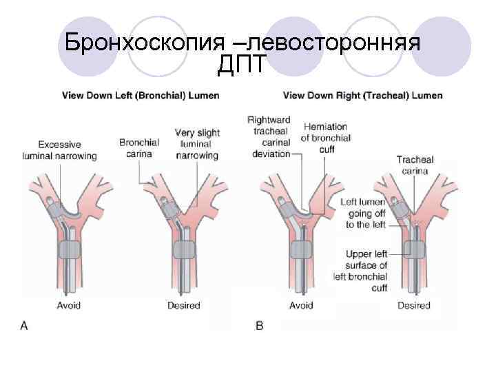 Бронхоскопия –левосторонняя ДПТ 