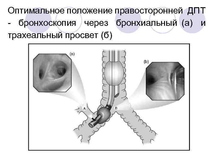 Оптимальное положение правосторонней ДПТ - бронхоскопия через бронхиальный (а) и трахеальный просвет (б) 