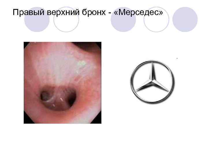 Правый верхний бронх - «Мерседес» 
