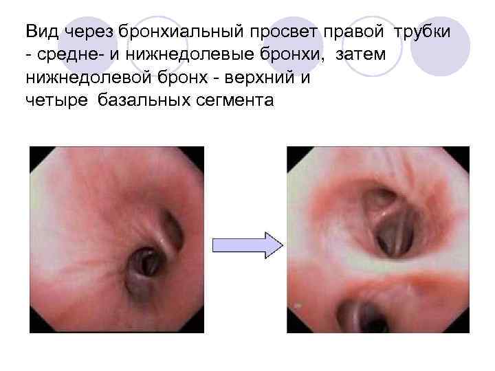 Вид через бронхиальный просвет правой трубки - средне- и нижнедолевые бронхи,  затем нижнедолевой бронх -
