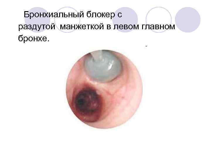 Бронхиальный блокер с раздутой манжеткой в левом главном бронхе. 