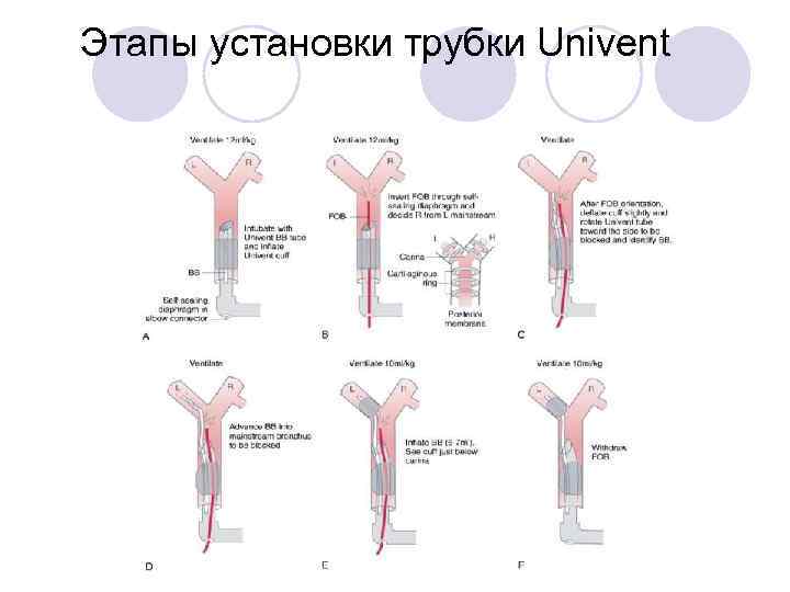 Этапы установки трубки Univent 