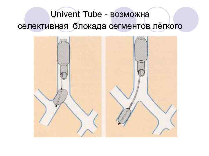 Univent Tube - возможна селективная блокада сегментов лёгкого 